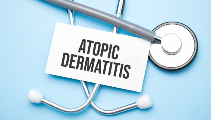 Atopic Dermatitis – Symptoms, Causes, and Remedies